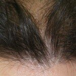 Alopecia: cuando el problema es quedarte calvo