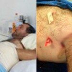 Bolsillo en su abdomen: así salva su mano de amputación